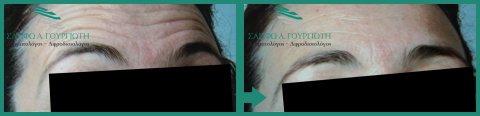 Αποτελέσματα Botox