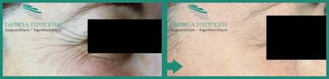 Αποτελέσματα Botox Πριν - Μετά