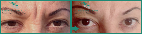 Αποτελέσματα Botox Πρίν - Μετά