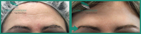 Αποτελέσματα Botox Πρίν - Μετά